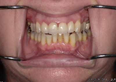 After photo of restorative dentistry treatment for a client | Paul J. Minnillo, DDS in Elyria, OH