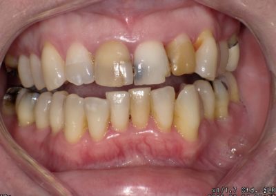 Patient's mouth before recieving cosmetic and restorative dental care | Paul J. Minnillo, DDS in Elyria, OH