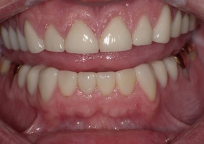 Cosmetic Dentistry after photo | Paul J. Minnillo, DDS in Elyria, OH