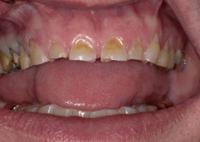 Cosmetic Dentistry Before photo | Paul J. Minnillo, DDS in Elyria, OH